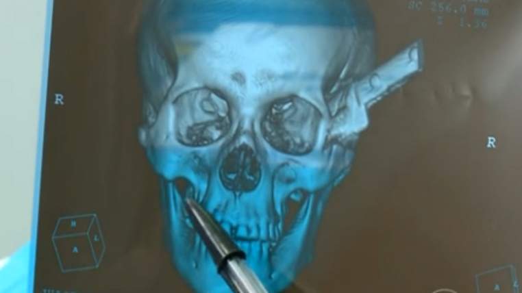 knife in head x ray